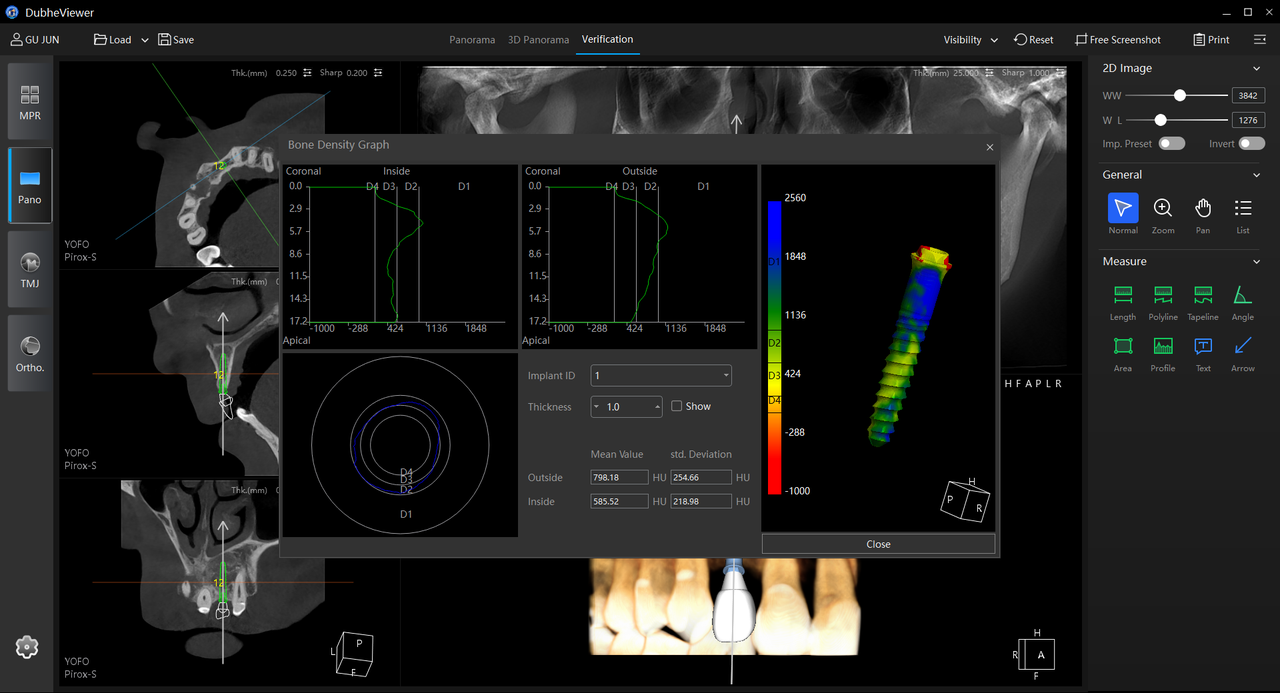 Bone density analysis interface