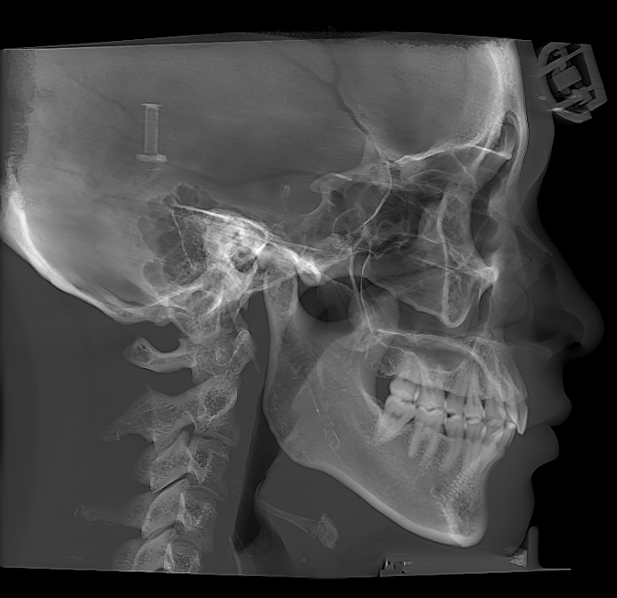 Unilateral lateral cephalometric view