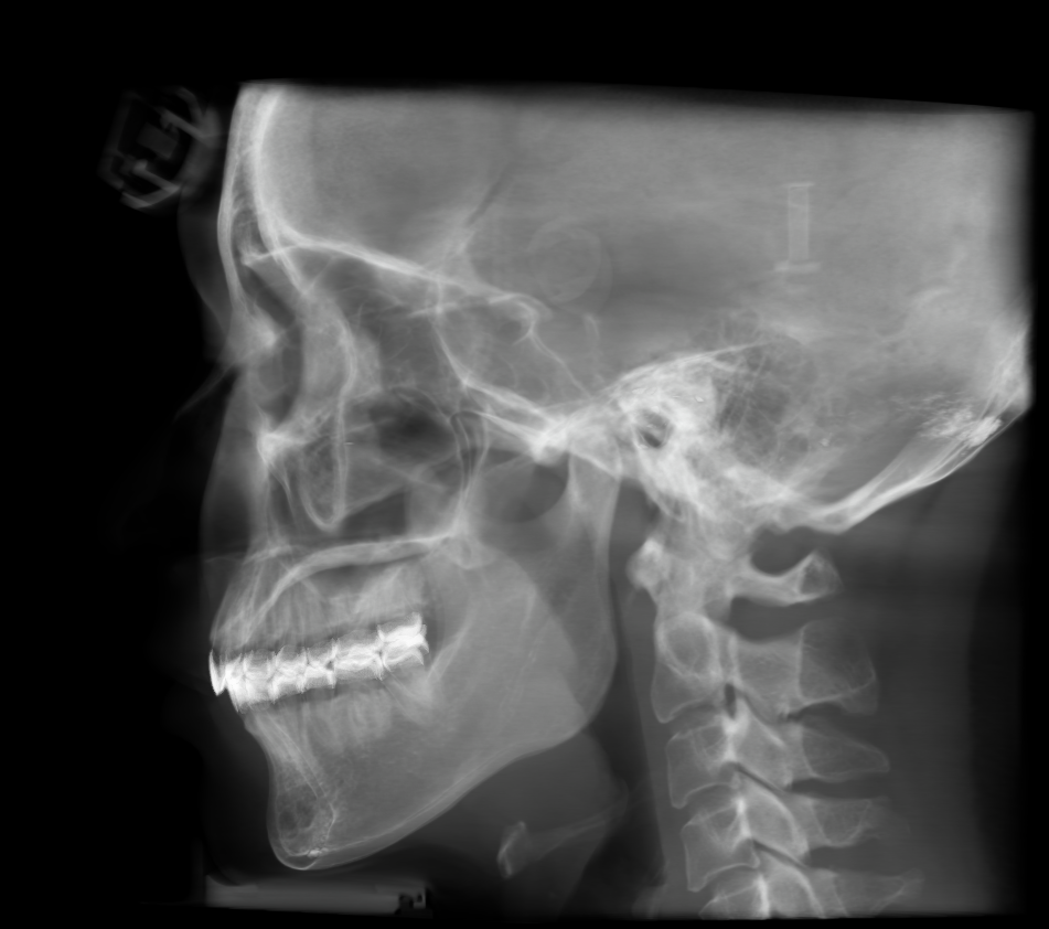 Airway rendering