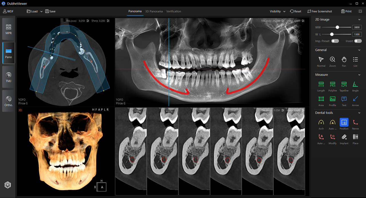 Automatic mandibular nerve mapping
