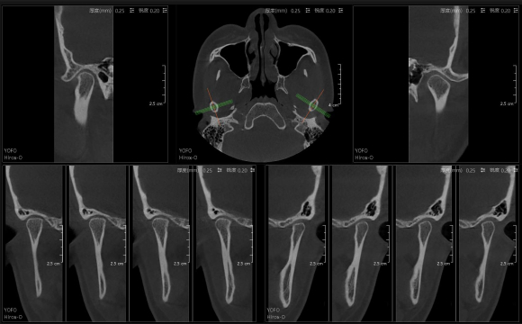 3D TMJ