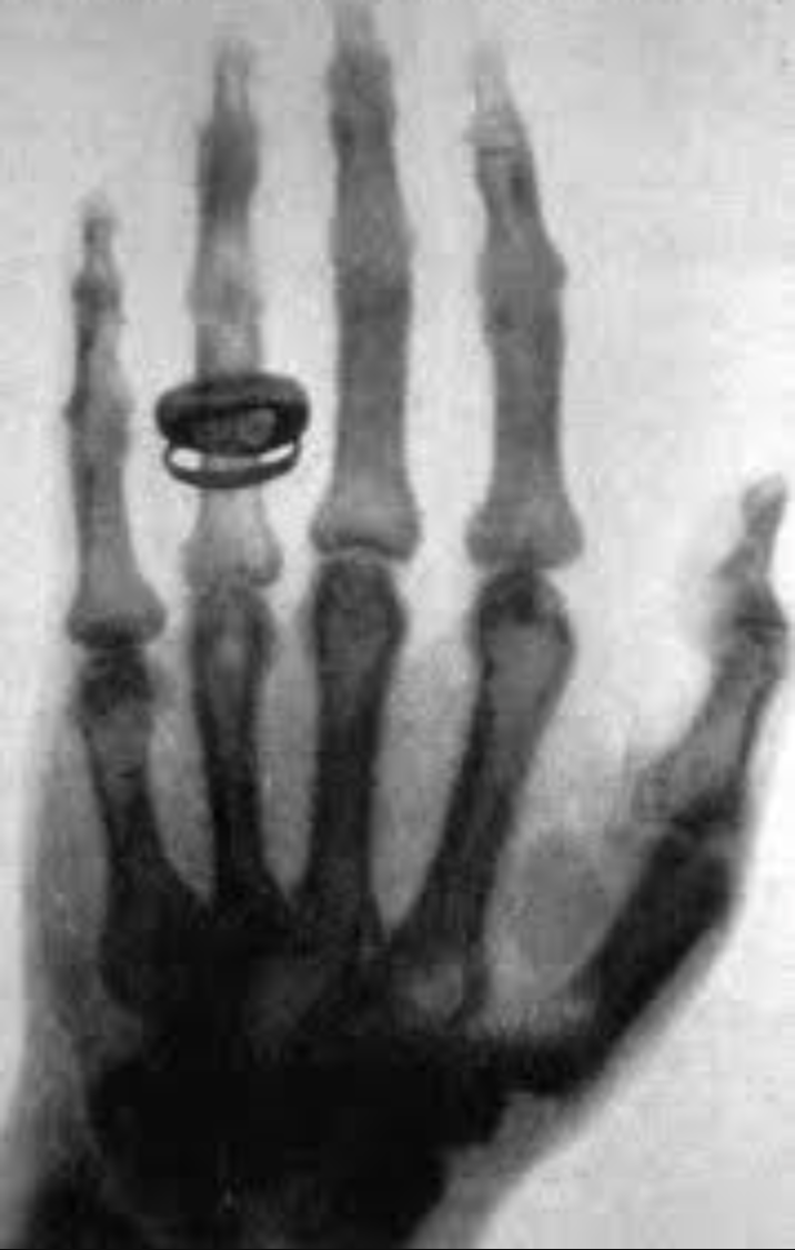 The first X-ray image of a hand
