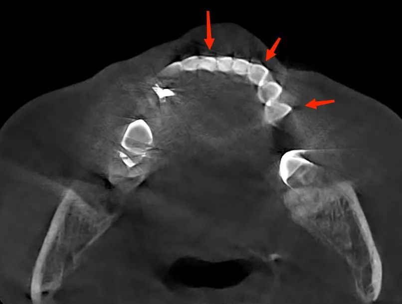 Cross-sectional dental CBCT image showing geometric distortion of a tooth caused by patient movement during scanning.