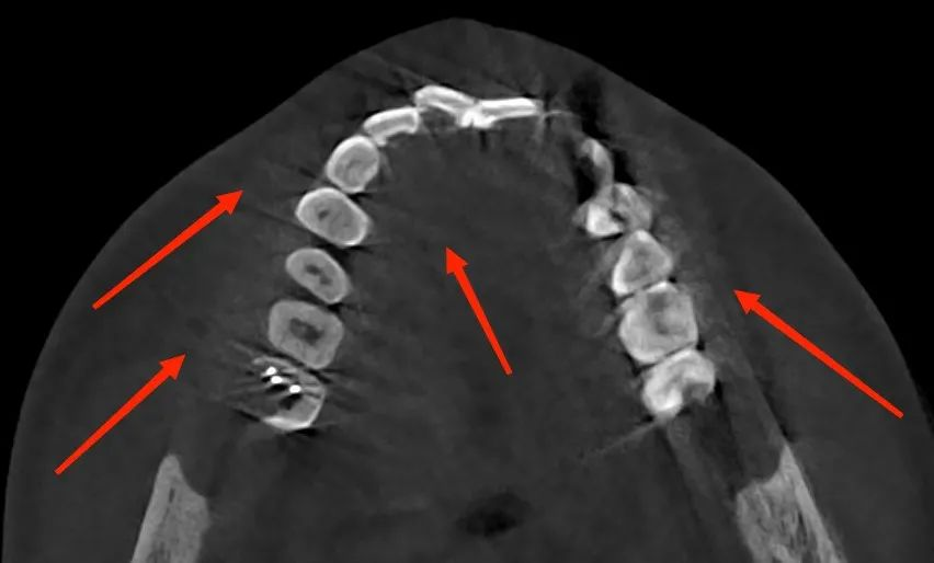 Dental CBCT image showing diagonal streak artifacts caused by sudden patient movement during scanning.