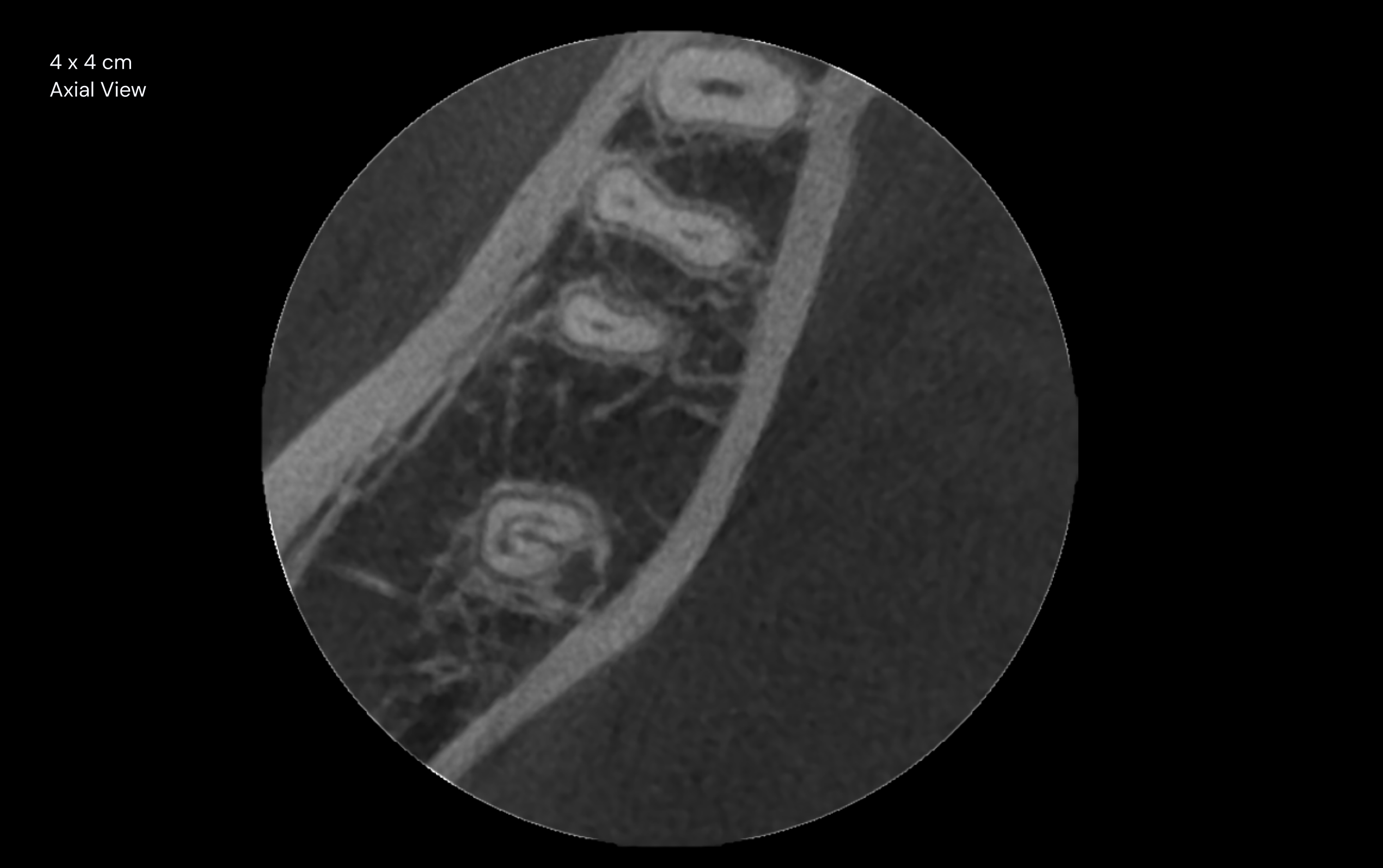 4 x 4 cm Axial View